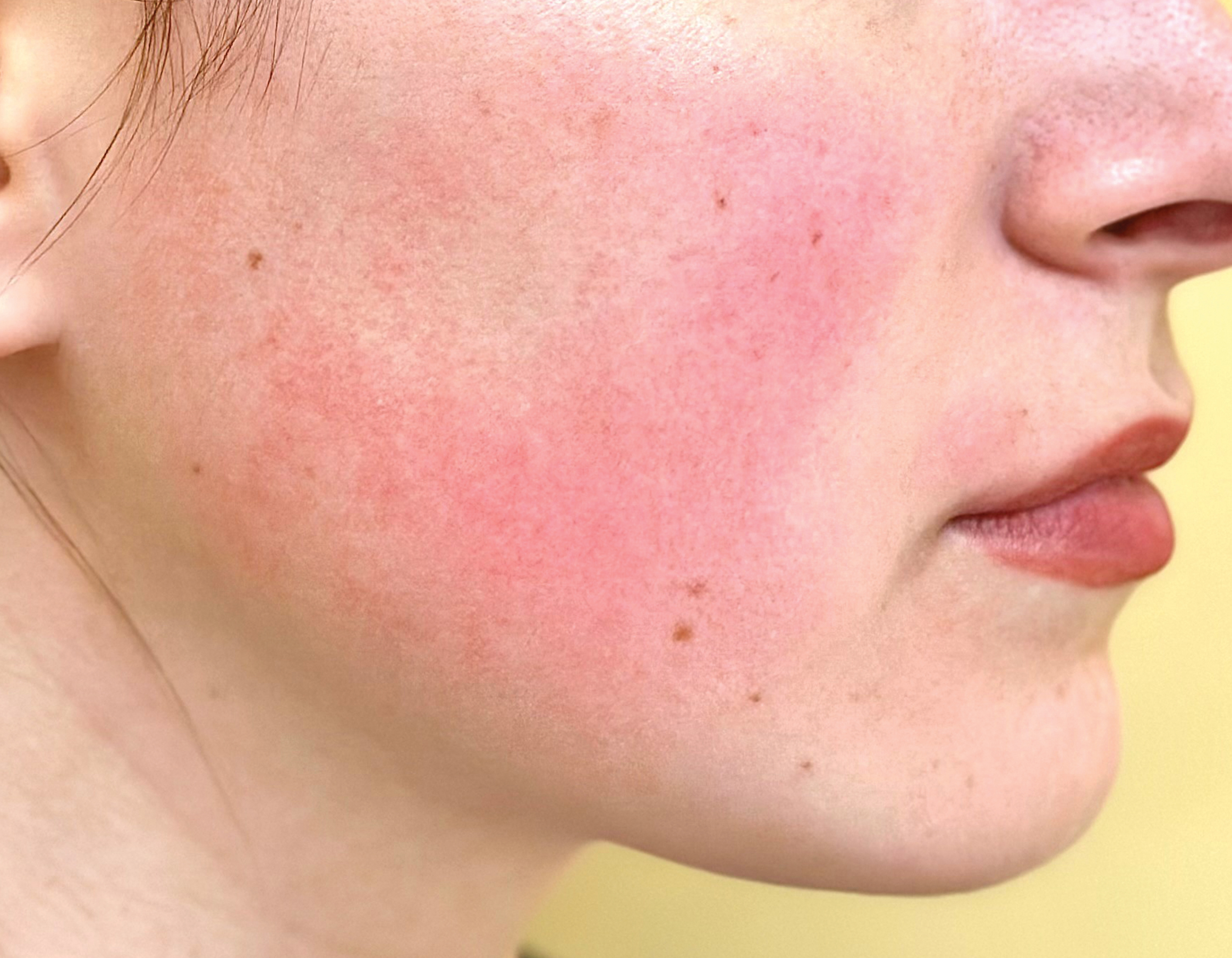 Un enemigo de tu piel ROSÁCEA 